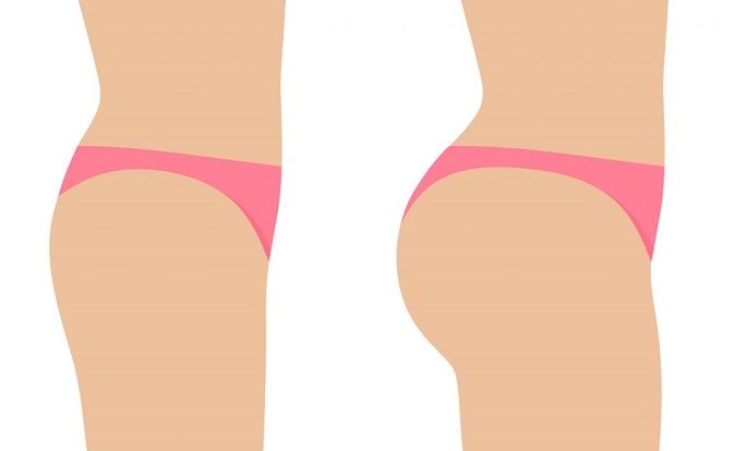 Battle of the Butt Lifts: Is Brazilian or Sculptra Best for You