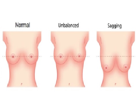Saggy Breasts (Breast Ptosis): Causes & Treatments